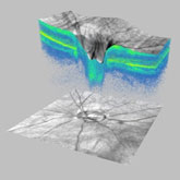 Cirrus HD-OCT Scanning Laser